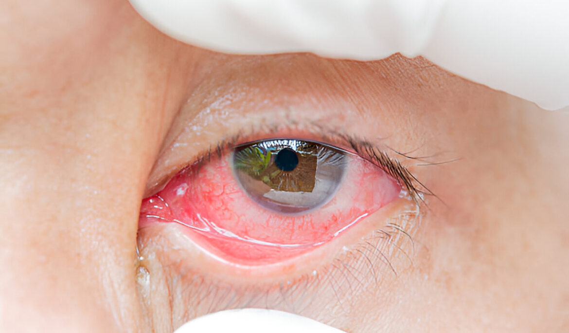 Why Are My Eyes Red? 9 Causes of Bloodshot Eyes and How to Find Relief - Empat Pillar Medika