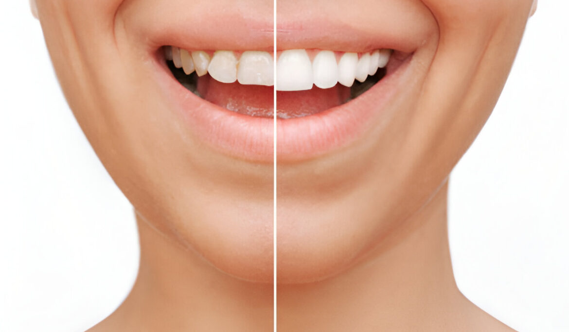 How Much Does a Dental Crown Cost? Average Prices With and Without Insurance - Empat Pillar Medika