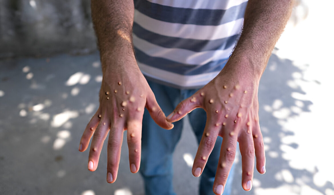 What is Monkeypox: What You Need to Know and How to Protect Yourself - Empat Pillar Medika