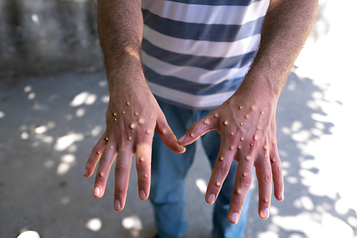 Monkeypox: What You Need to Know and How to Protect Yourself