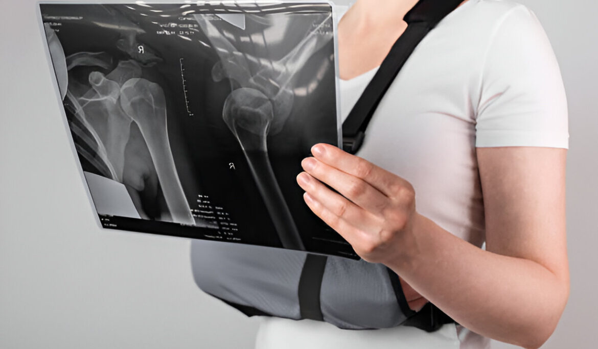 Broken Collarbone (Clavicle Fracture): A Complete Guide to Understanding, Treatment, and Recovery - Empat Pillar Medika