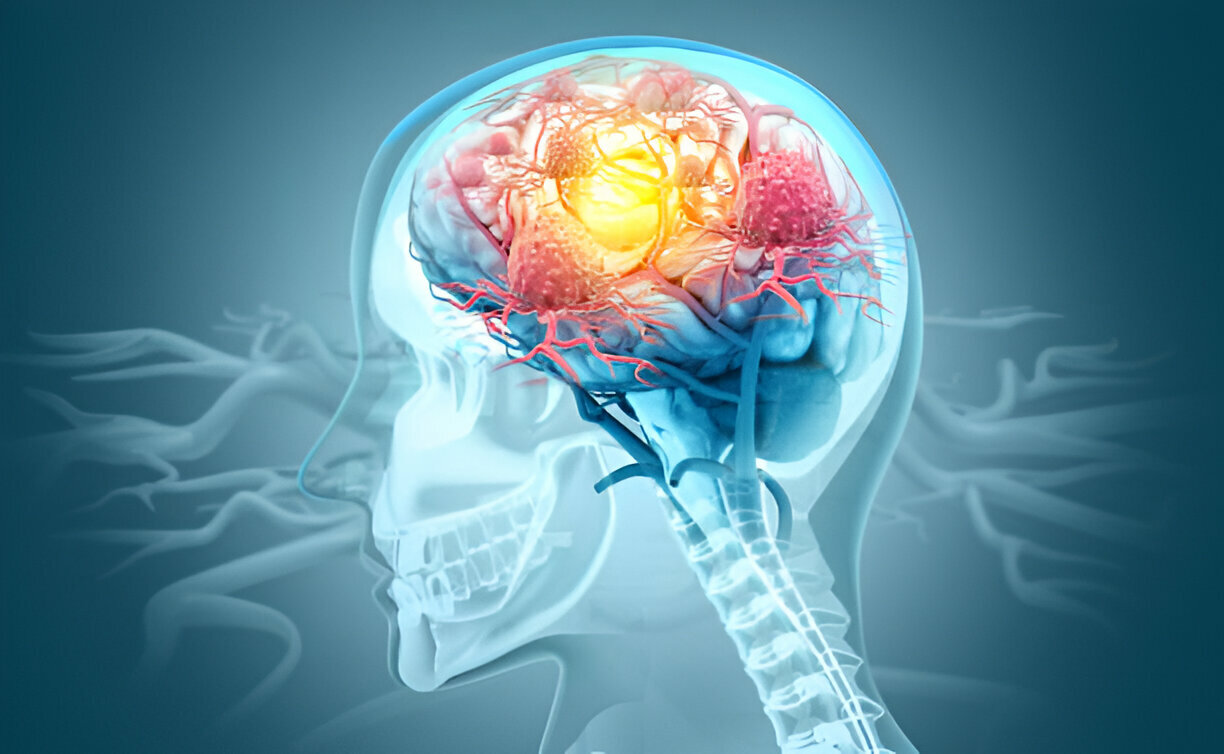 Autoimmune Encephalitis: Decoding the Causes, Symptoms