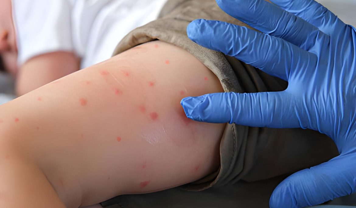Why the Role of Vitamin A in Measles Treatment is Paramount - Empat Pillar Medika