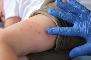 Why the Role of Vitamin A in Measles Treatment is Paramount - Empat Pillar Medika